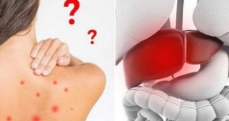 Dấu hiệu nhận biết nóng trong người và cách điều trị nóng trong